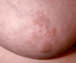 dermatitis on breast