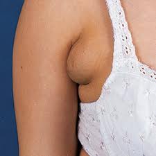 https://www.breastfeedingbasics.com/wp-content/uploads/2014/12/BFB-Woman-extra-breast-tissue-arm-2014.jpg